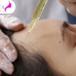 Best-Hair-Transplant-in-Vadodara